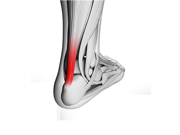 Image of Achilles strain