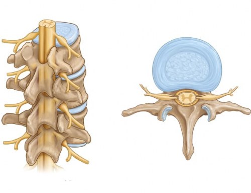 Lumbar disc injury
