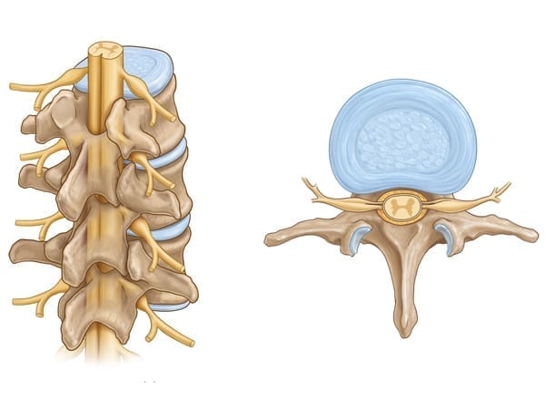 Lumbar disc injury