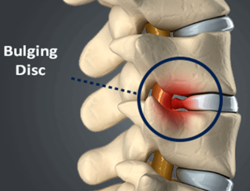 Understanding Disc Bulge Injuries: Effective Treatment and Recovery with Physiotherapy