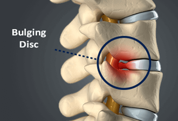 Disc Bulge Physio Eastern Suburbs