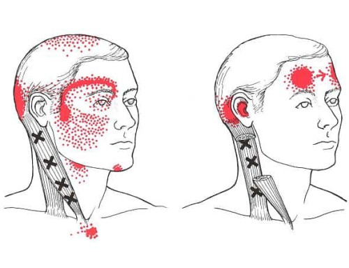 Cervicogenic Headaches – Effective Relief Through Physiotherapy