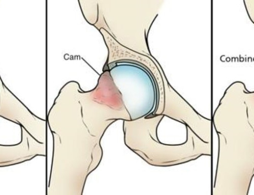 Understanding FAI (Femoroacetabular Impingement)