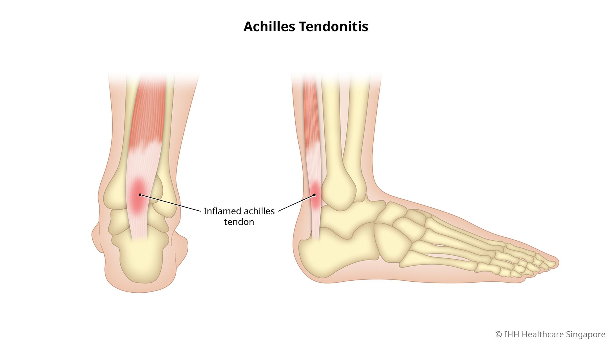 Achilles Tendonitis Physio Eastern Suburbs - Maroubra & Waverley