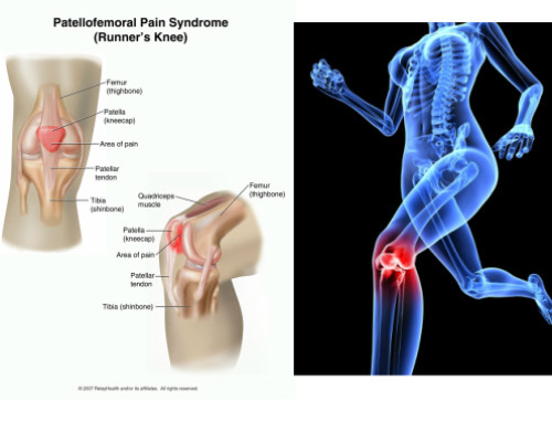 Patellofemoral Pain – The Athlete or Runner’s Enemy