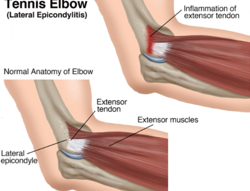 Tennis Elbow – Understanding the Pain and Regaining Your Swing