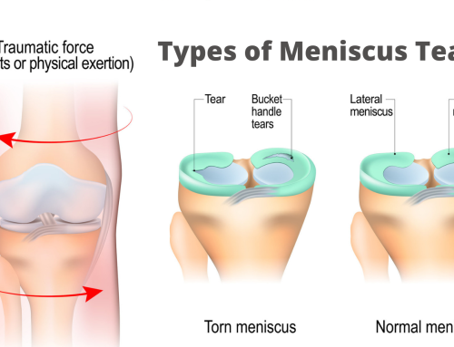 Meniscus Injuries – Helping You Bounce Back