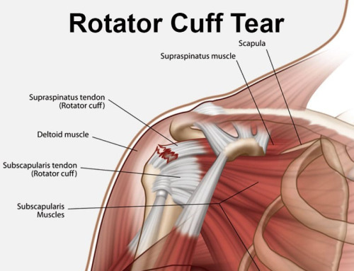 Understanding Rotator Cuff Tears: Your Path to Recovery with Physiotherapy