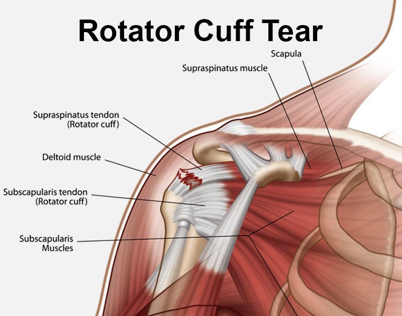 Understanding Rotator Cuff Tears: Your Path to Recovery with
